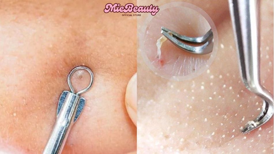 Cây Nặn Mụn Mua Ở Đâu? Cây Nặn Mụn Là Gì?