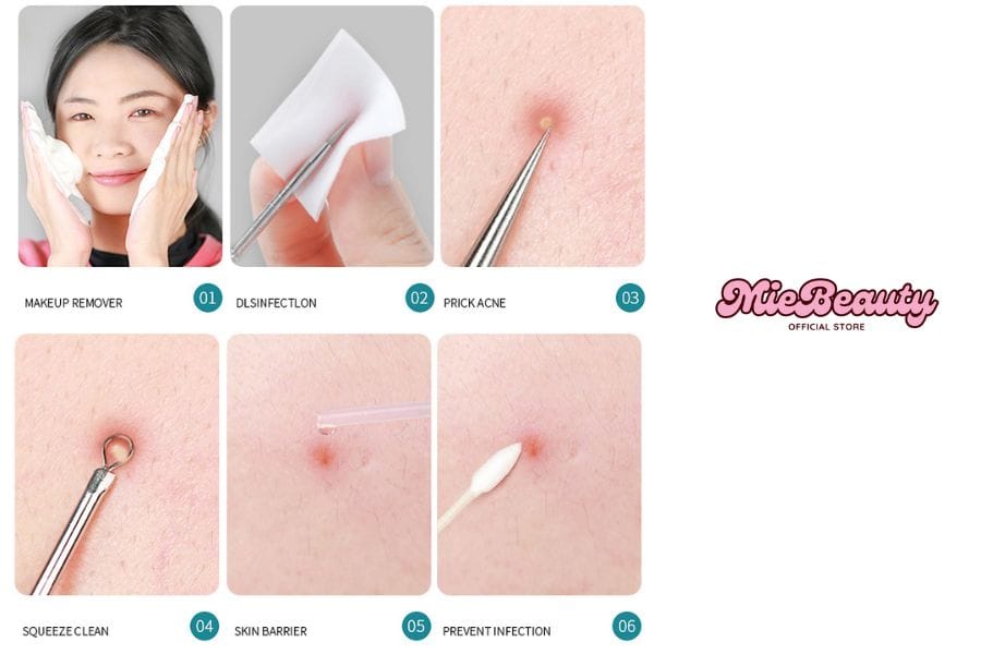 Hướng dẫn sử dụng cây nặn mụn an toàn tại nhà